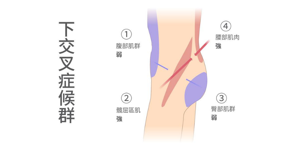 2種運動改善下交叉症候群